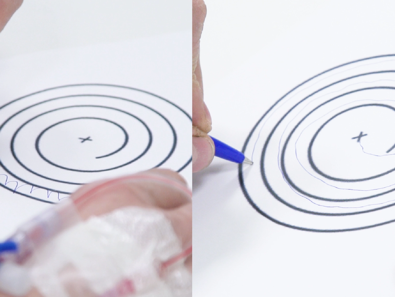  Pioneros en eliminar el temblor esencial y síntomas del Párkinson sin incisiones con Neuro-HIFU
