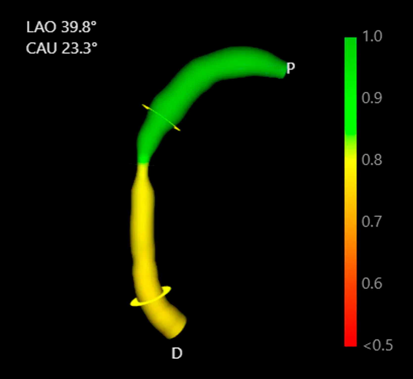 Coronary Physiology Assessment (vFFR) – Unique in Valencia