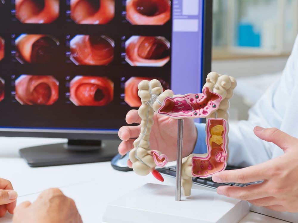 Early detection of colon cancer 