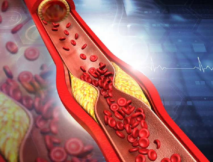 Early detection of heart attack and other coronary diseases
