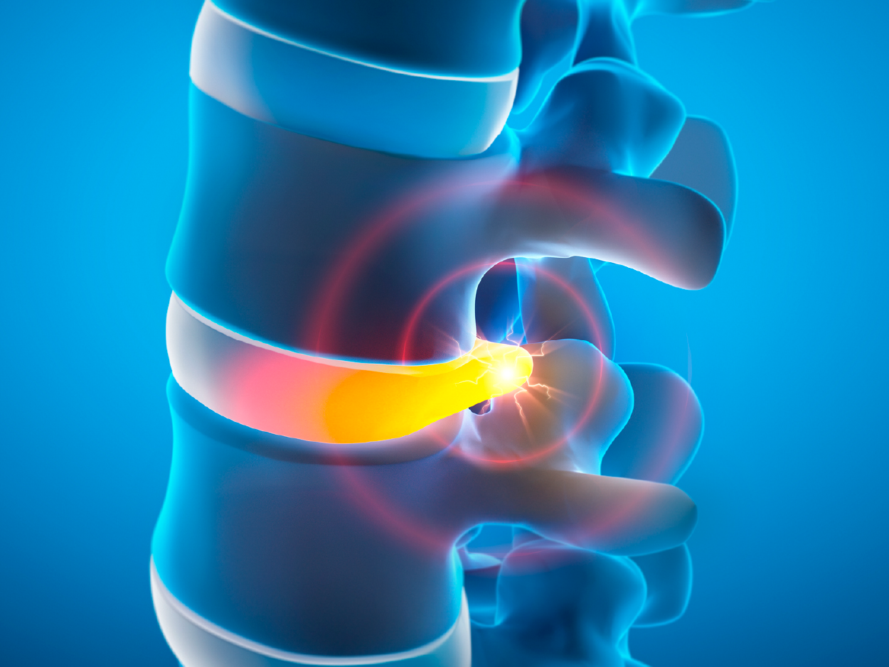 Tratamiento efectivo para el dolor sin cirugía de la hernia discal