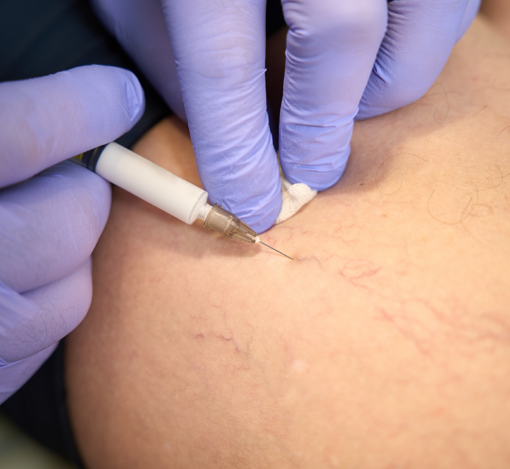 Varicose Vein Treatments Without Hospital Admission or Open Surgery